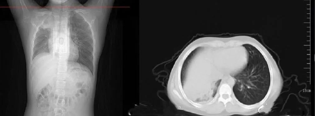 武汉12岁男孩惊现白肺:身体不会骗你(图2) 63.jpg