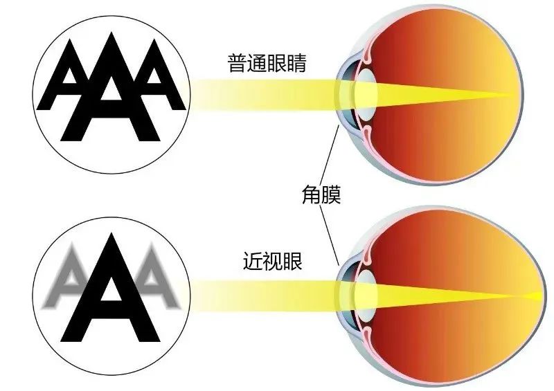 中国近7亿人近视,给你验光配镜的人却有90%不合格(图5) 29.jpg