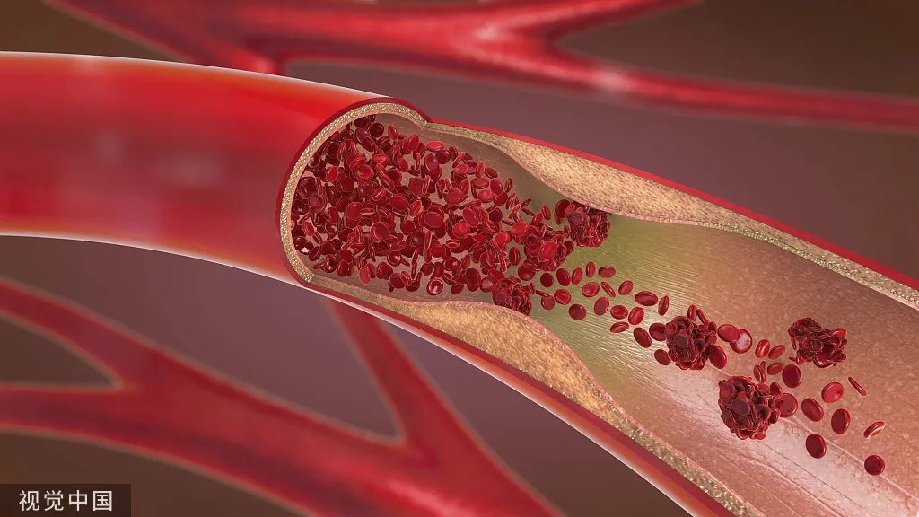 注意了!身体有这6种变化,提醒你该查血脂了(图4) 23.jpg