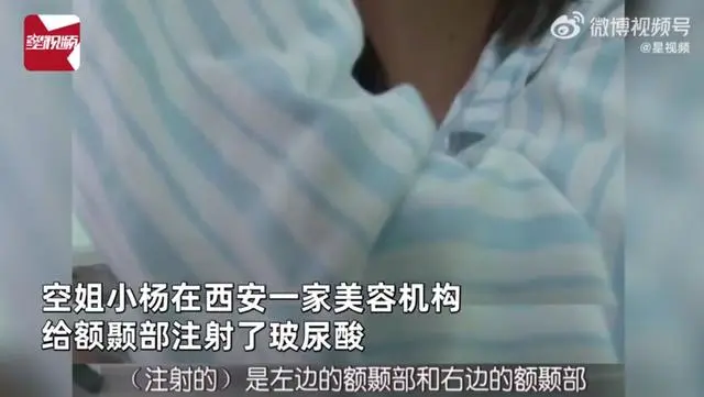 空姐注射玻尿酸打进血管,差点丧命!头扎200多针被“放血”,官方:涉事医生还没找到(图1) 空姐注射玻尿酸打进血管,差点丧命!头扎200多针被“放血”,官方:涉事医生还没找到(图1)