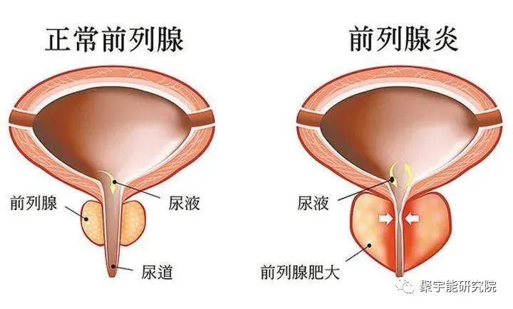 金日光教授:随记前列腺炎之事【定量解读《黄帝内经》之感悟•之二十九】(图1) 1.jpg