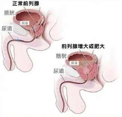 金日光教授:随记前列腺炎之事【定量解读《黄帝内经》之感悟•之二十九】(图3) 3.jpg