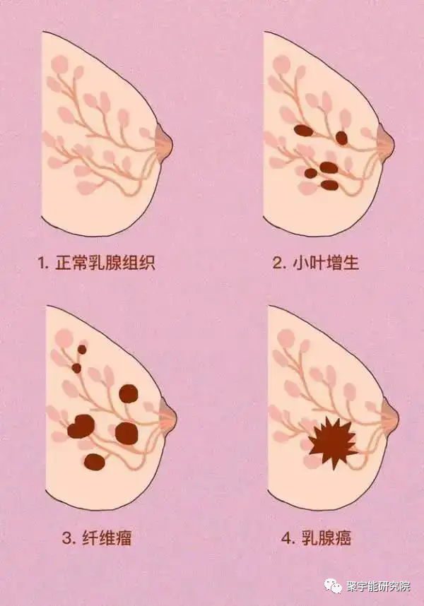 金日光教授:【《黄帝内经》漫谈•之六】林佳媚主任很想知道女性乳腺癌里生命动力阴阳源精分布(图1) 1.png