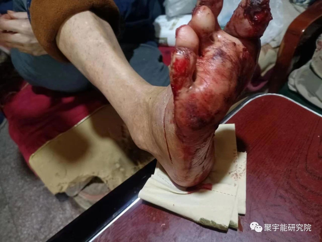 金日光教授:【《黄帝内经》漫谈•之十八】钟伟东先生又发明了严重糖尿病者可以不用截肢!(图2) 2.jpg