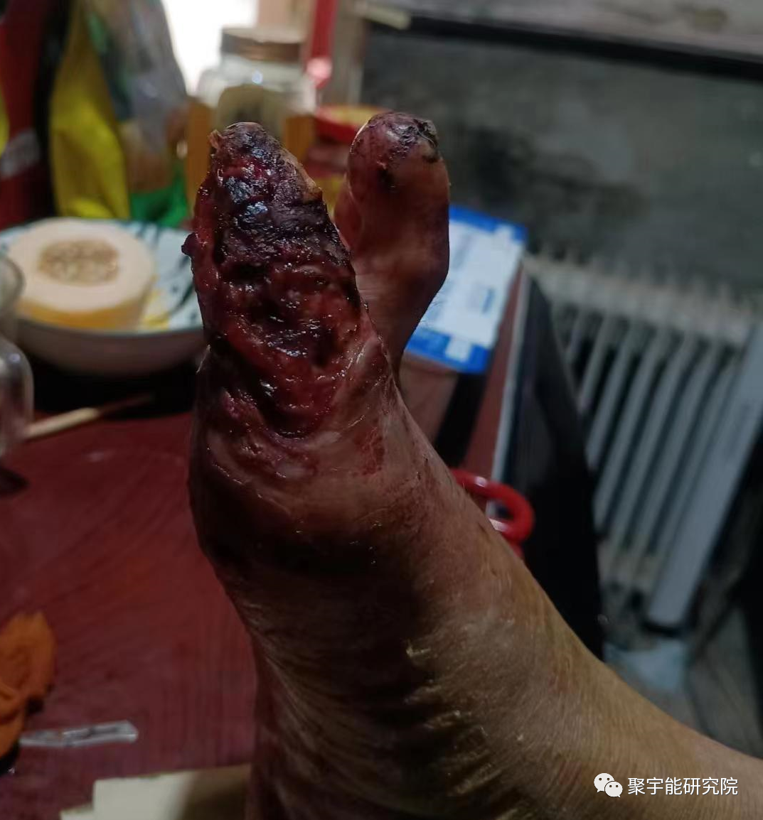 金日光教授:【《黄帝内经》漫谈•之十八】钟伟东先生又发明了严重糖尿病者可以不用截肢!(图3) 3.png