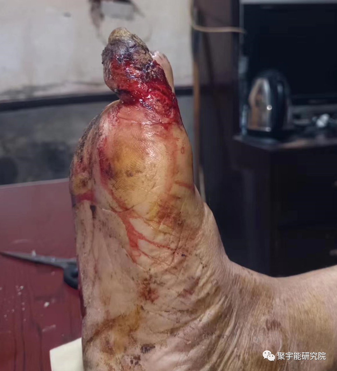 金日光教授:【《黄帝内经》漫谈•之十八】钟伟东先生又发明了严重糖尿病者可以不用截肢!(图4) 4.png