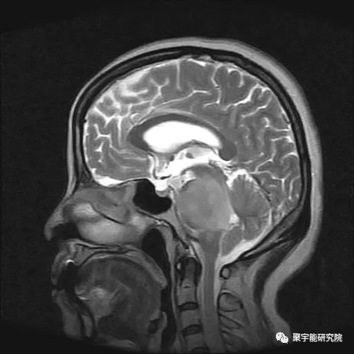 金日光教授:【《黄帝内经》漫谈•之二十六】脑癌能否能诊治?(图1) 1.jpg