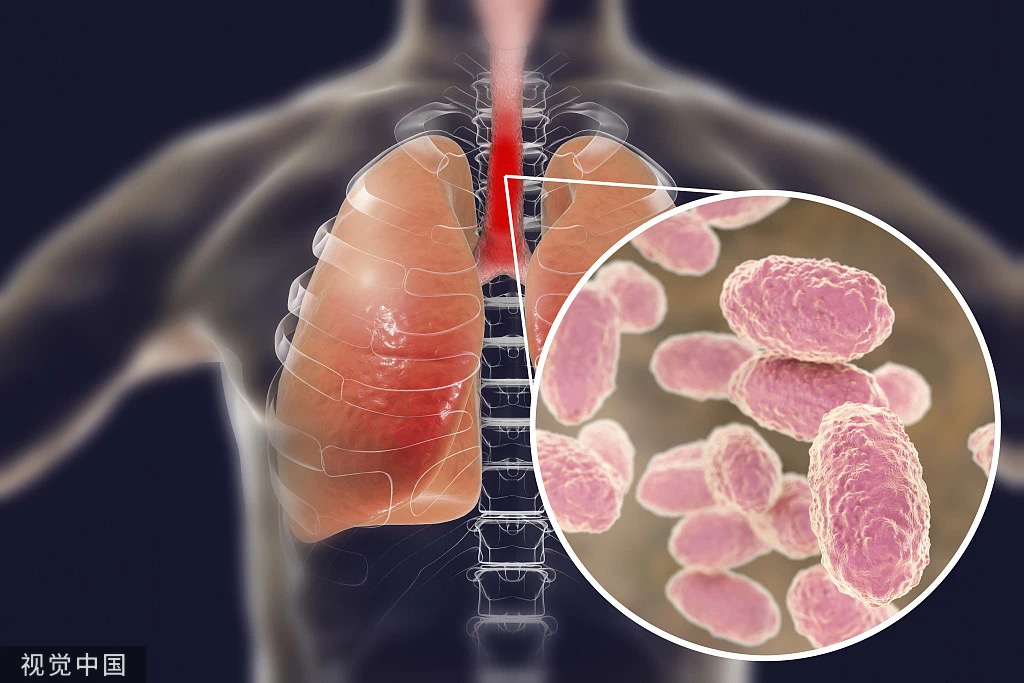 今年已致13死,何为“百日咳”?(图6) 7.jpg