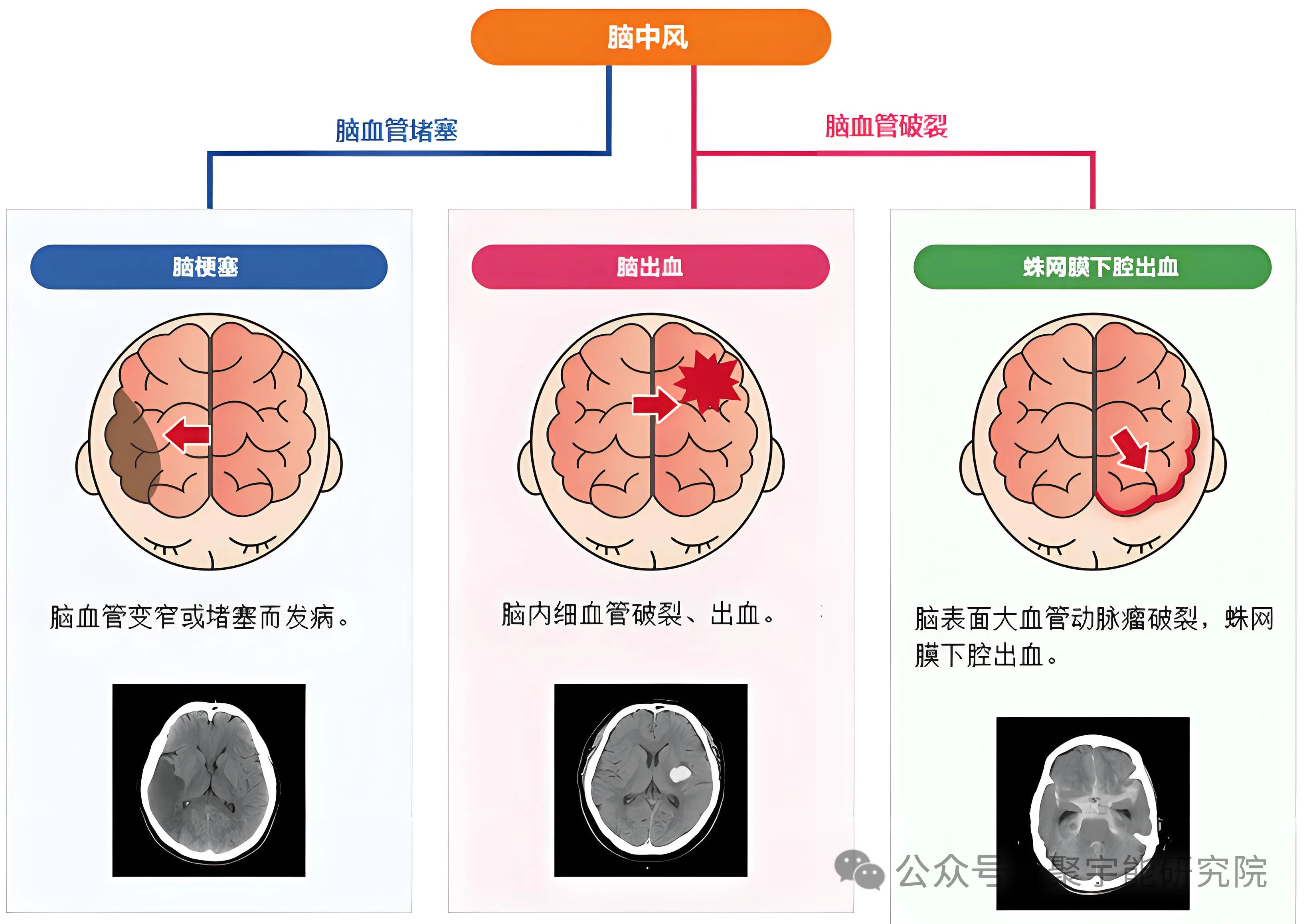金日光教授:【《黄帝内经》为何是中医大学科最上等的医典?•三十九】有群友说,现在<脑中风>是个<头号杀手>!怎么办?(图1) 6.jpg