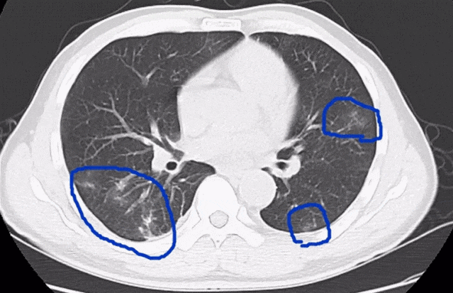 大闸蟹上市!小伙一顿吃7只后入院抢救,医生提醒→(图4) 640.gif