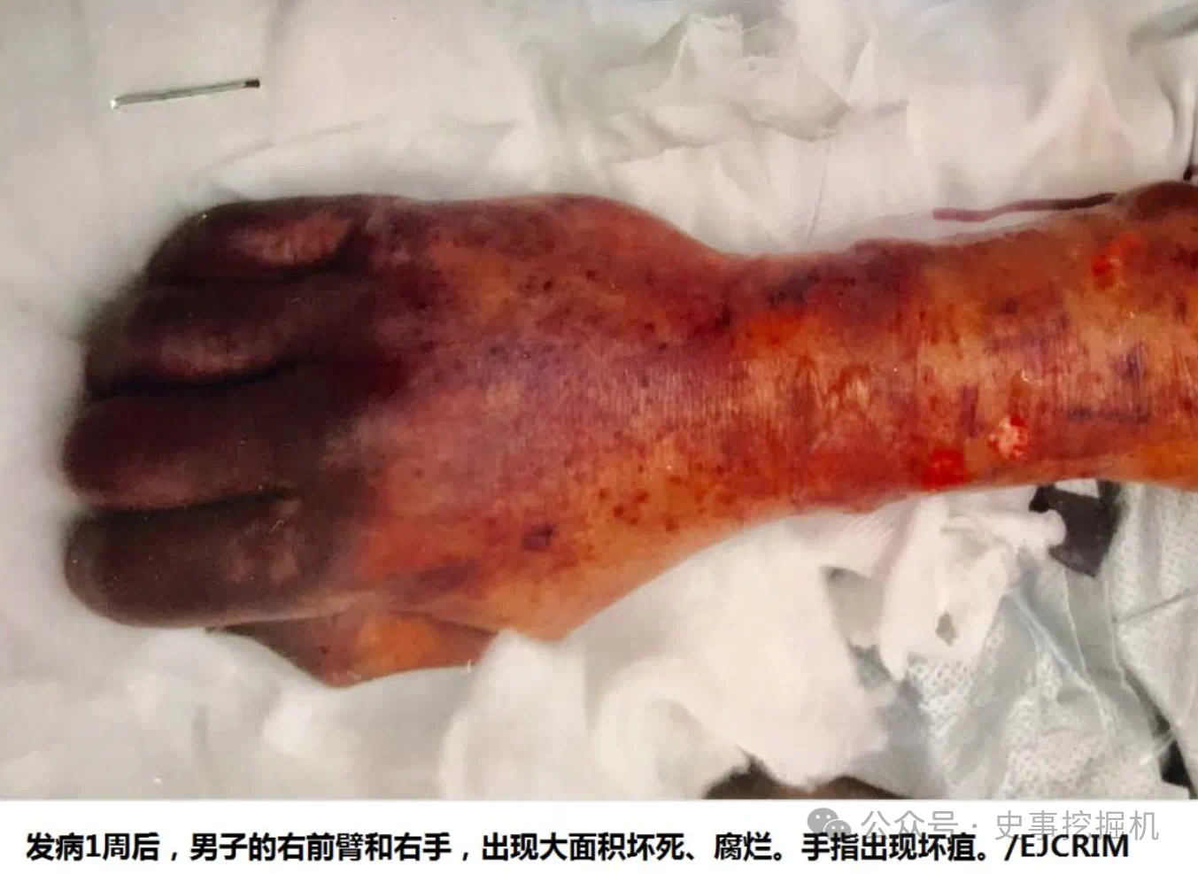 男子被爱犬舔了一口,多器官衰竭死亡!病因不是狂犬病…(图2) 4.png