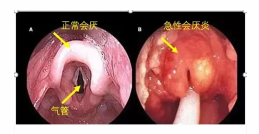 女子从就诊到去世仅10分钟!这种病千万别以为是上火(图4) 图片